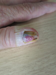 悪性黒色腫　一部黒いが赤い腫瘤になっている。